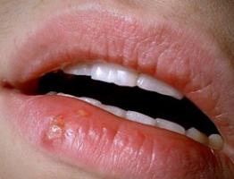 Простуда на губах: лечение в домашних условиях – все варианты